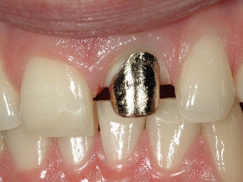 Thân Răng Sứ Giả Là Gì?