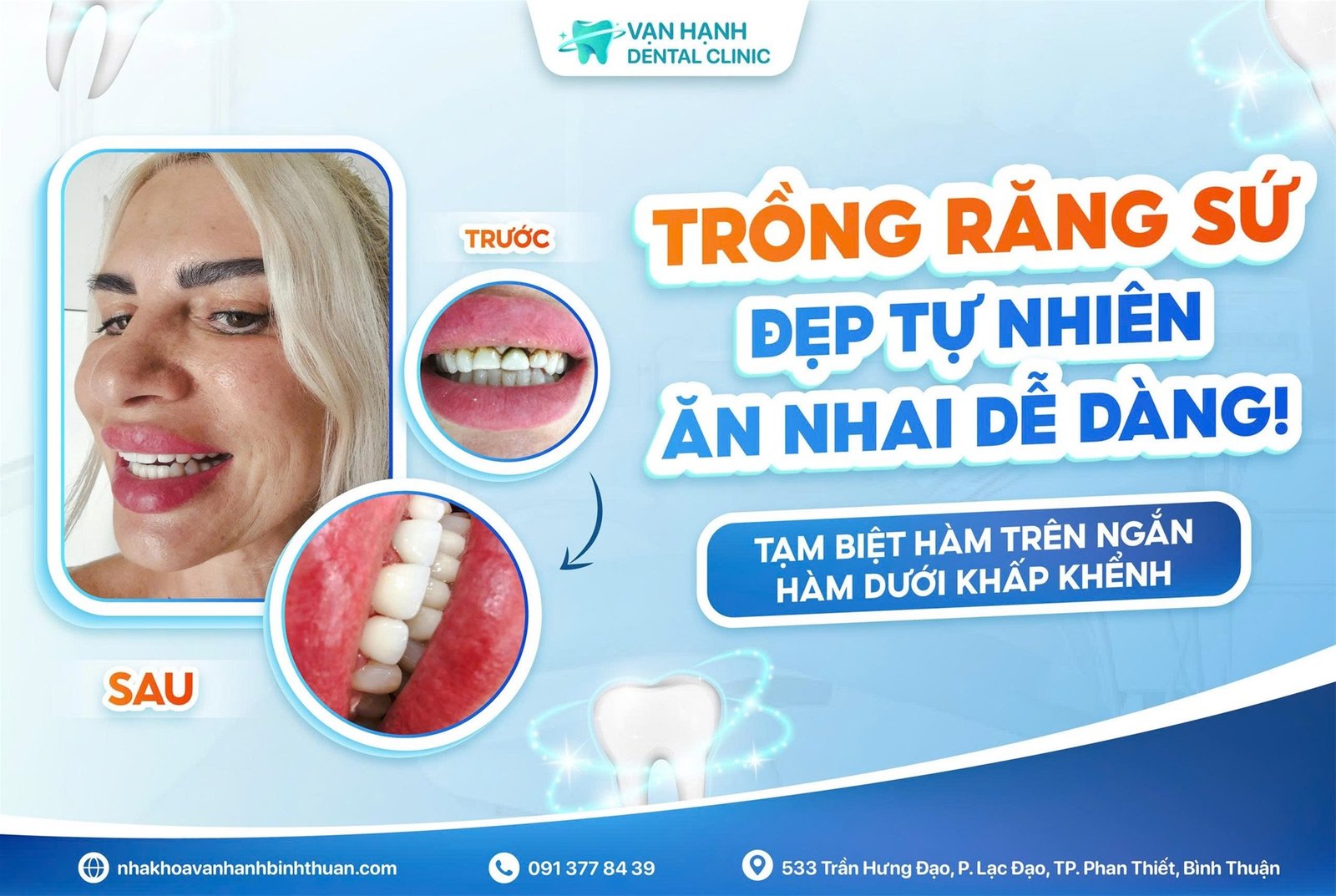 TẠM BIỆT HÀM TRÊN NGẮN, HÀM DƯỚI KHẤP KHỂNH - TRỒNG RĂNG SỨ ĐẸP TỰ NHIÊN, ĂN NHAI DỄ DÀNG