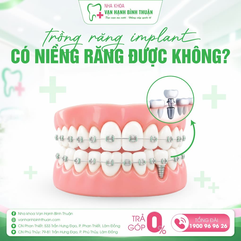 trồng răng implant có niềng răng được không
