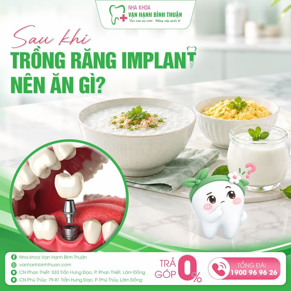 sau khi cấy implant nên ăn gì