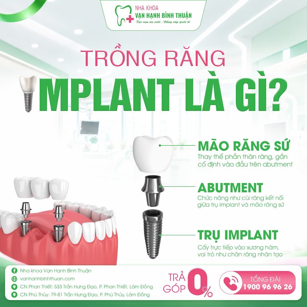 trồng răng implant là gì