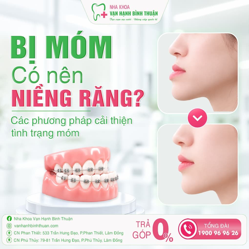 Bị móm có nên niềng răng