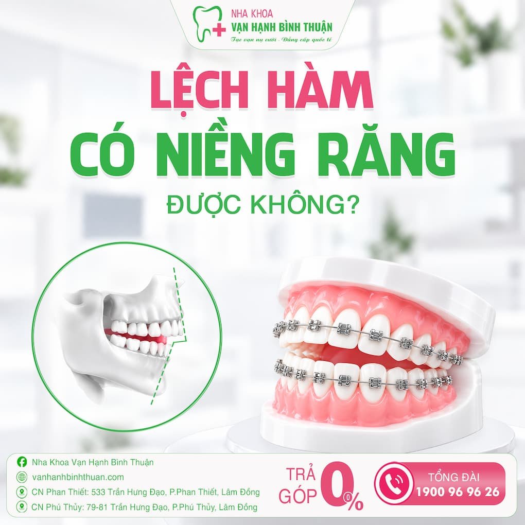 lệch hàm có niềng răng được không