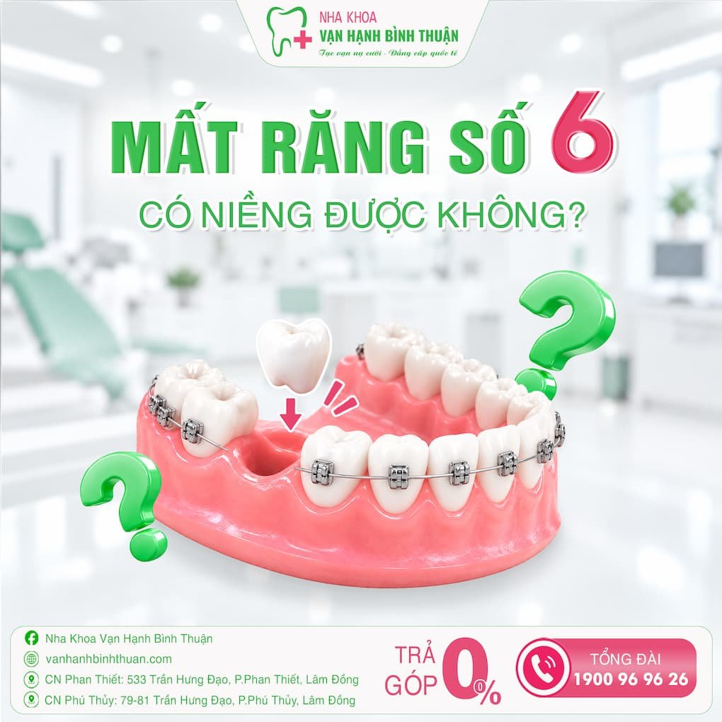mất răng số 6 có niềng được không
