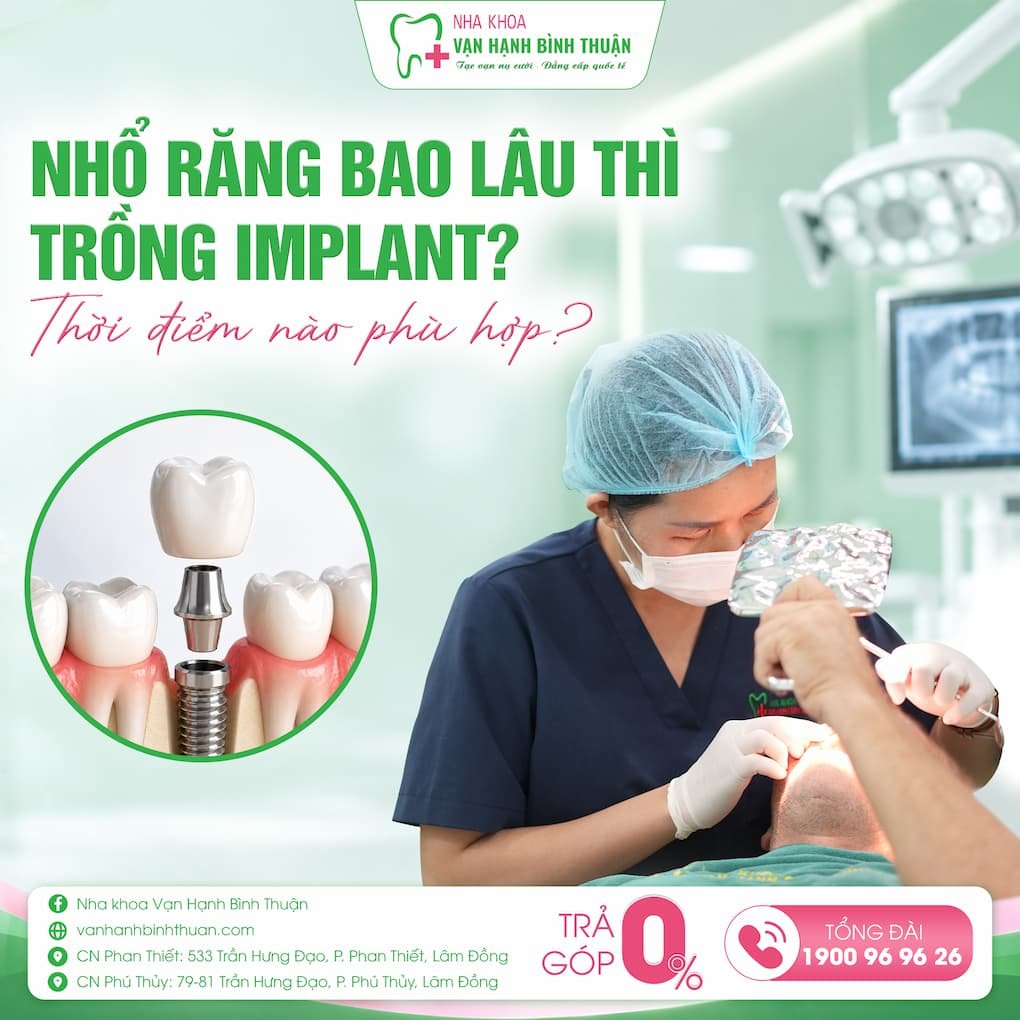 nhổ răng bao lâu thì trồng implant